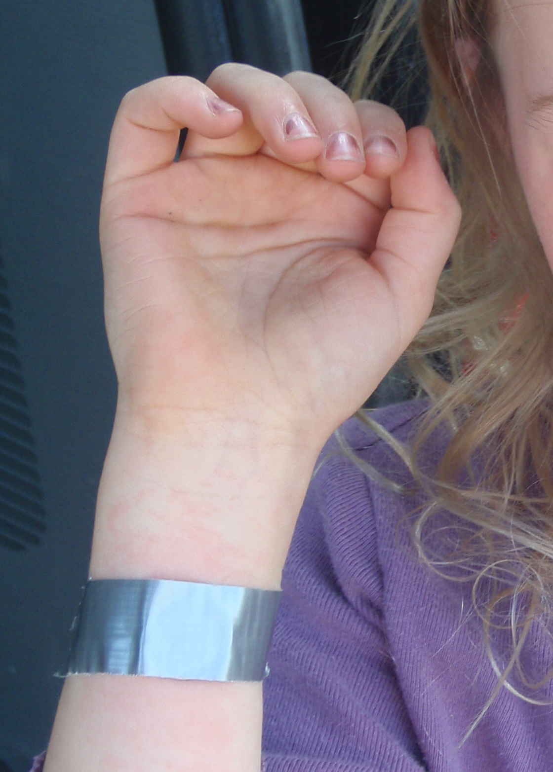 bee sting