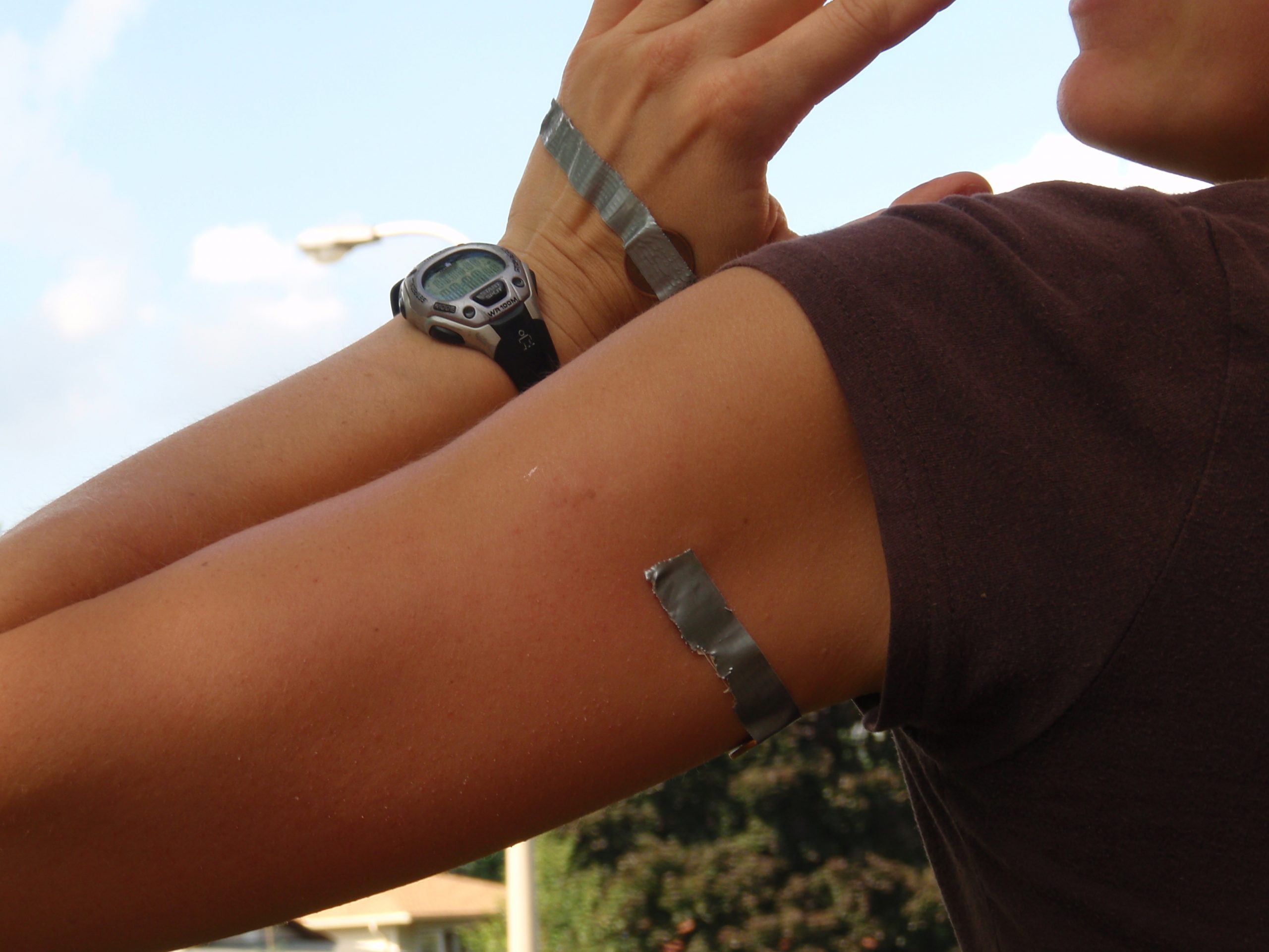 bee stings